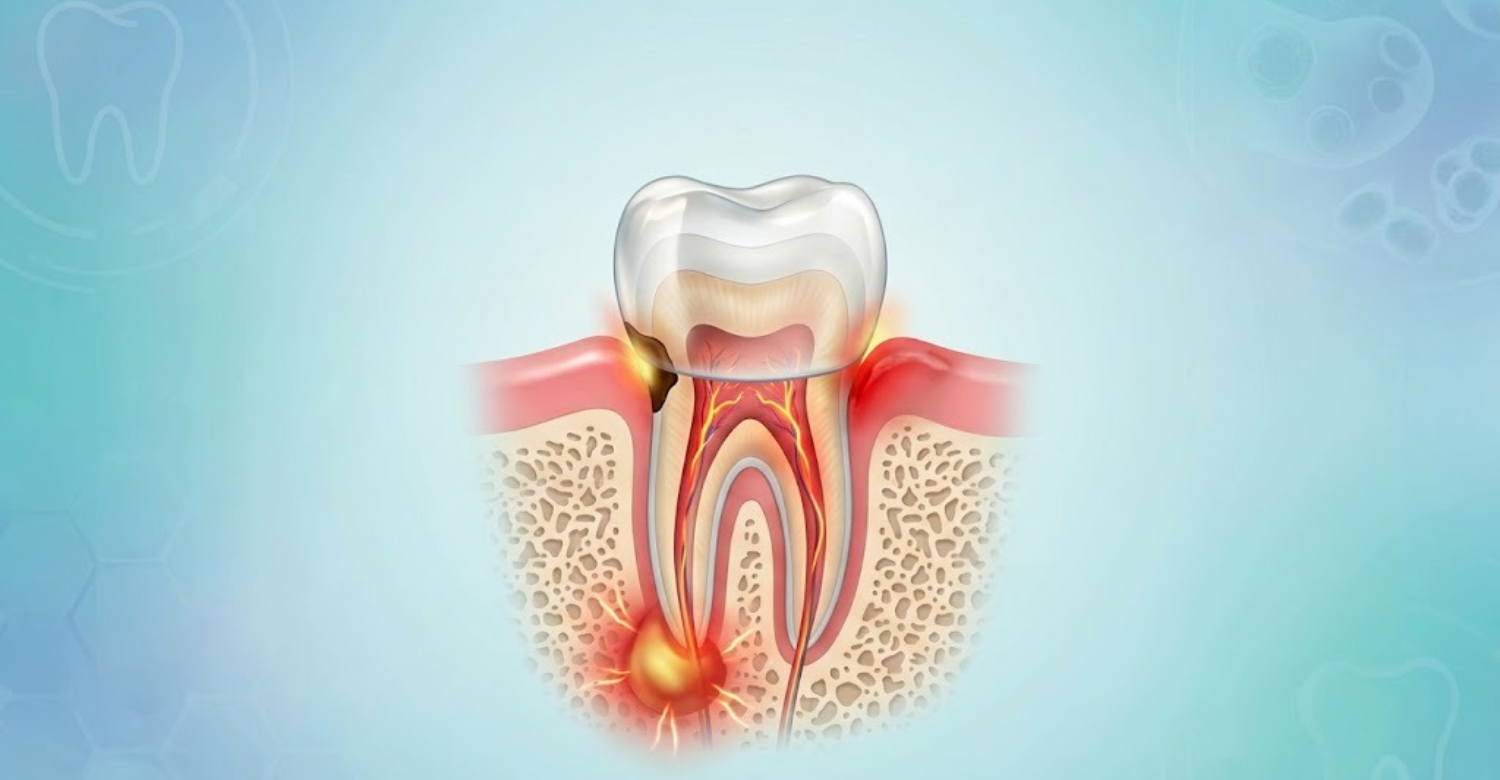 Causes Dental Crown Tooth Pain1